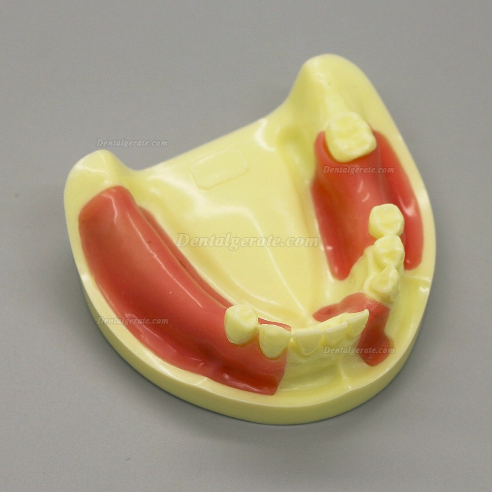 Dental Model # 2004 01 - Unterkieferimplantat-&Uuml;bungsmodell mit Gingiva